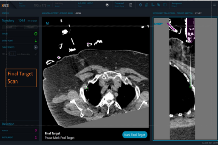 Right Lung Apex Lesion - XACT